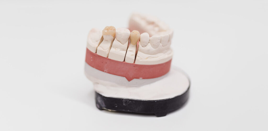 Moderner Zahnersatz in Würzburg – individuell angepasst für ein sicheres Gefühl und ein schönes Lächeln.