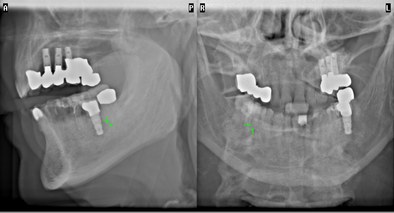 Zahnimplantate in Würzburg für ein natürliches Gefühl und neue Lebensqualität.